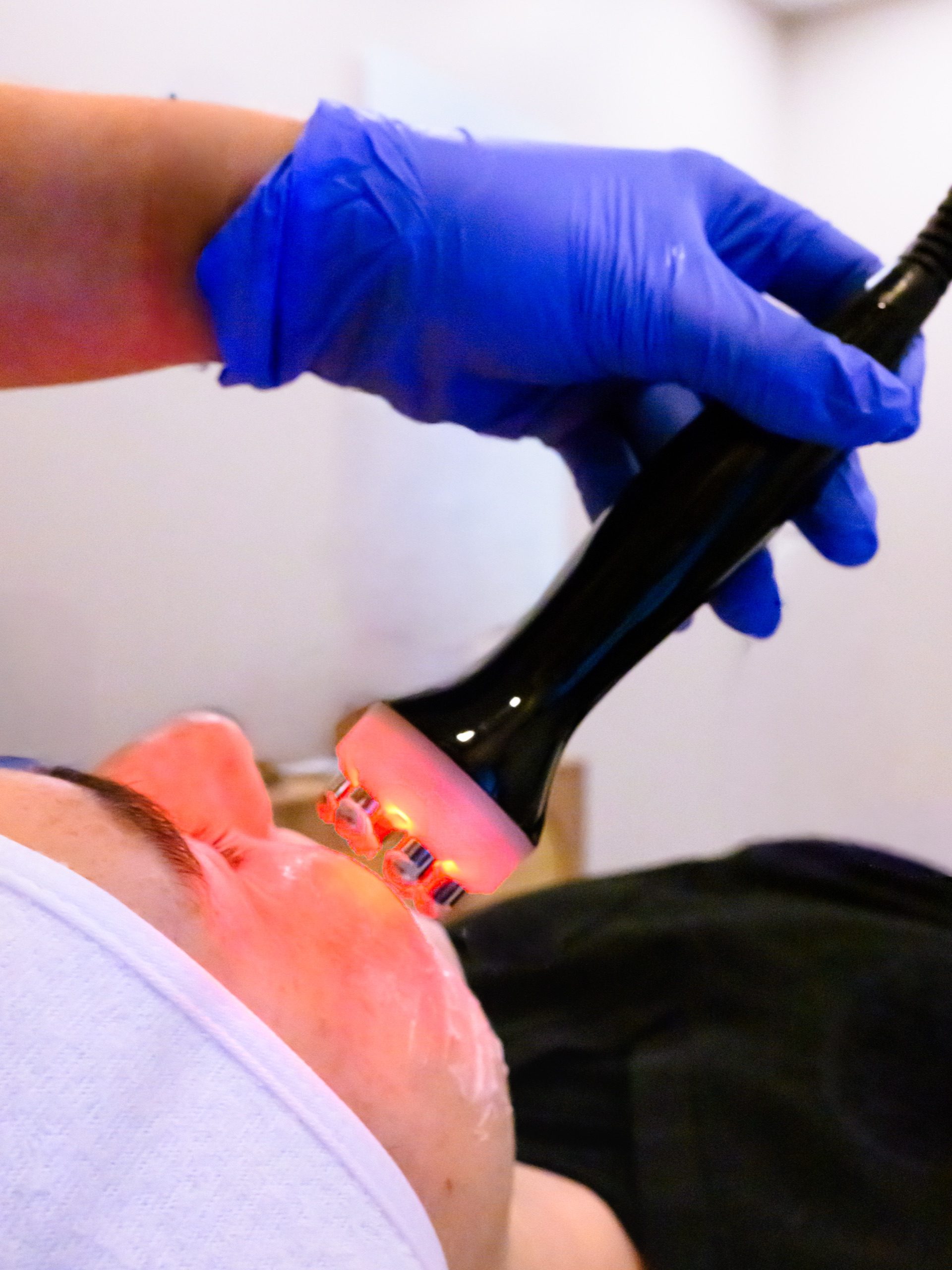 RF Face facial (6-Pole)- 1 - client