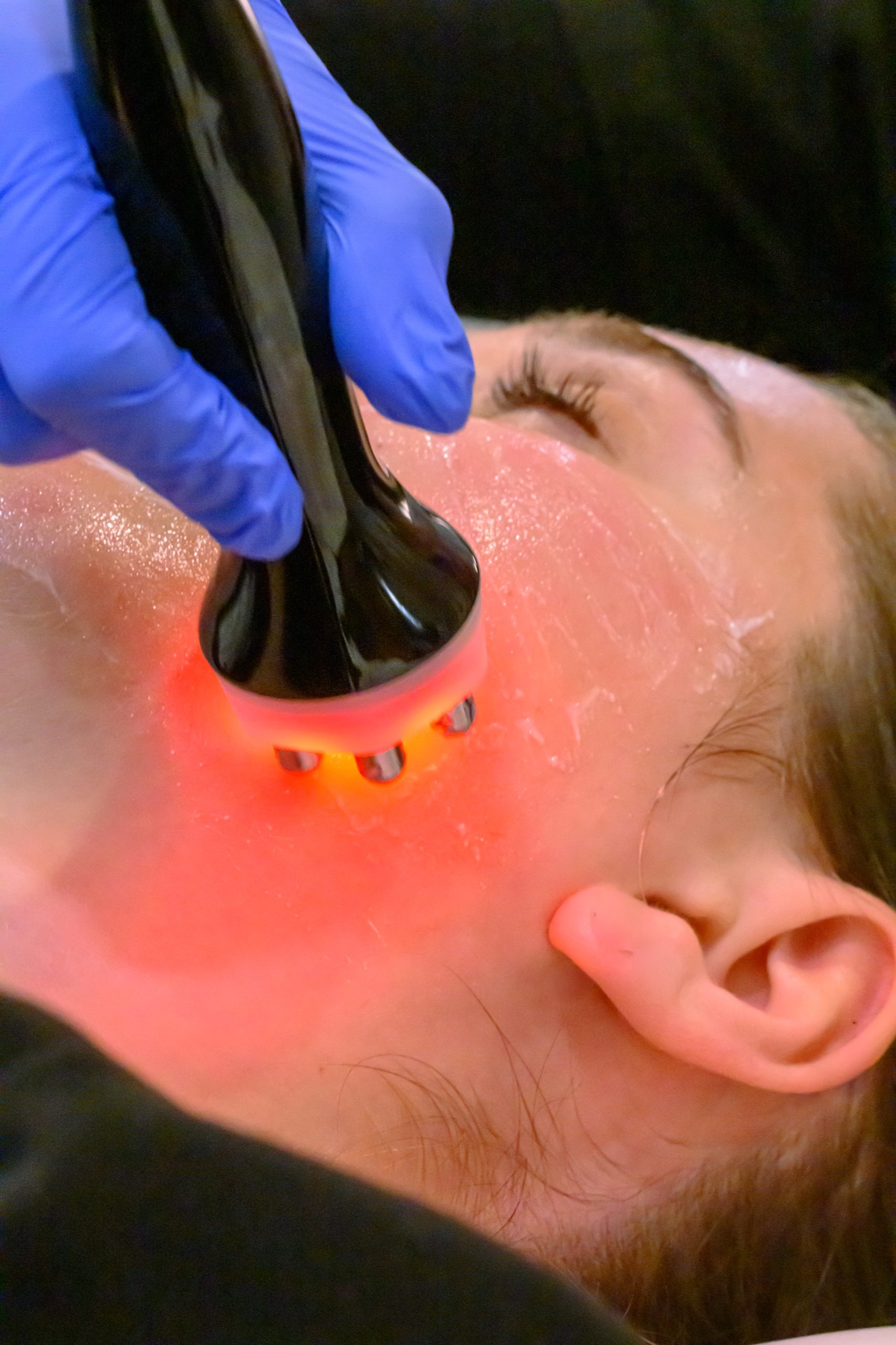 RF Face facial (6-Pole)- 12 - client