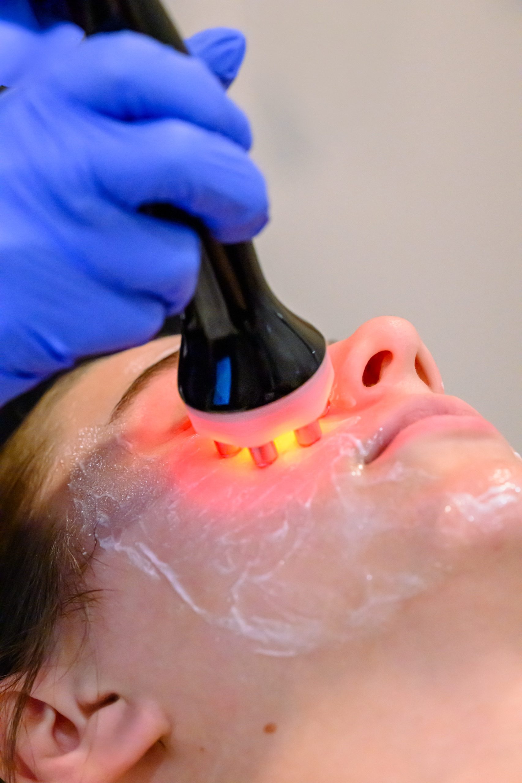 RF Face facial (6-Pole)- 13 - client