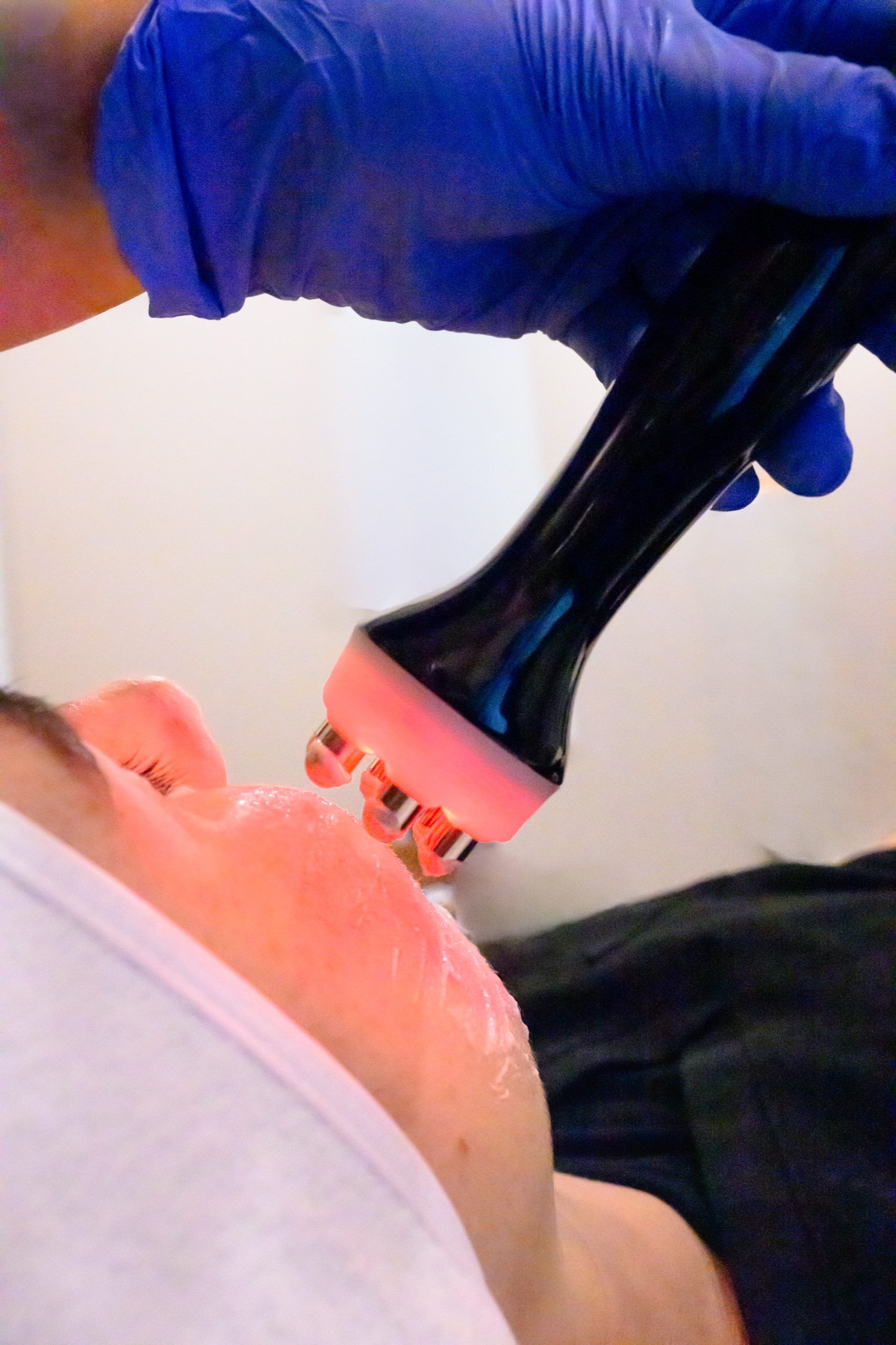 RF Face facial (6-Pole)- 2 - client