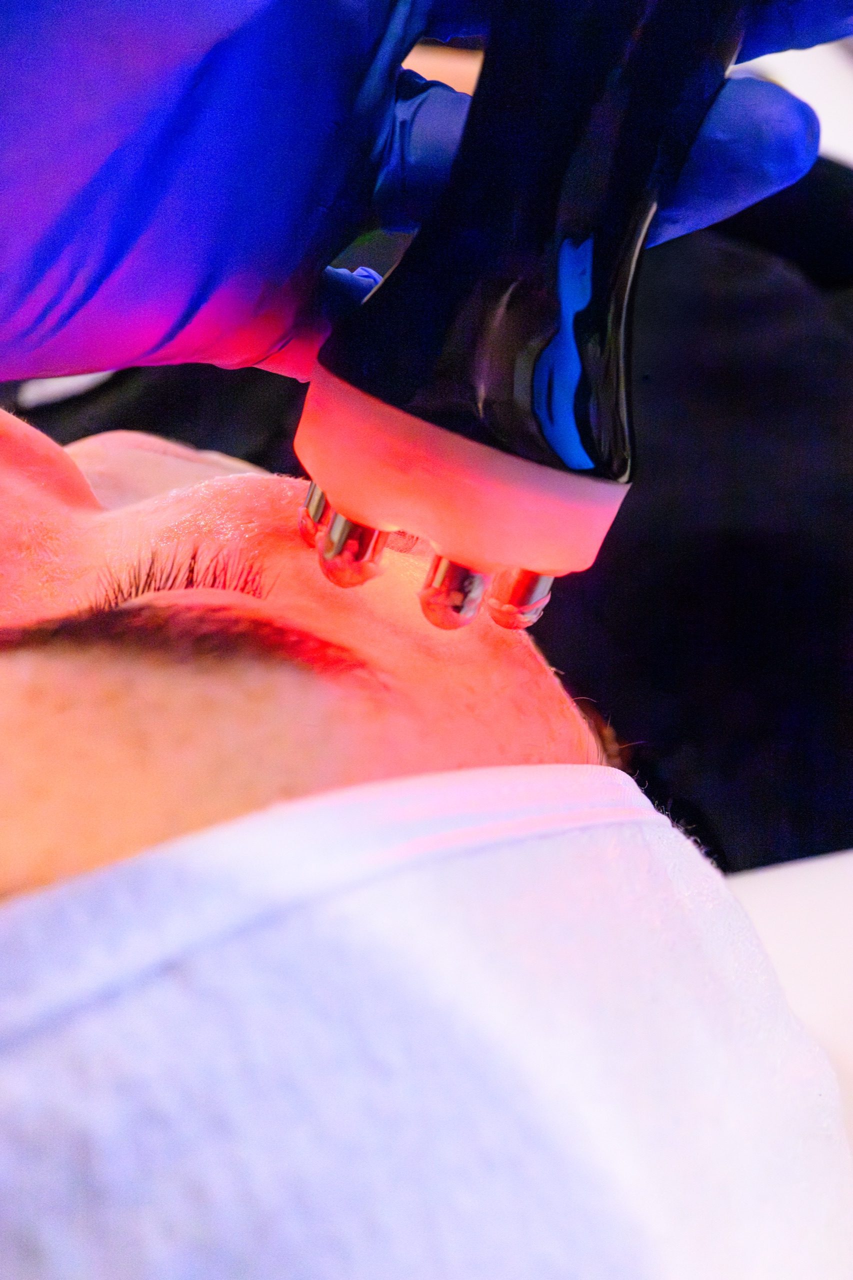 RF Face facial (6-Pole)- 3 - client