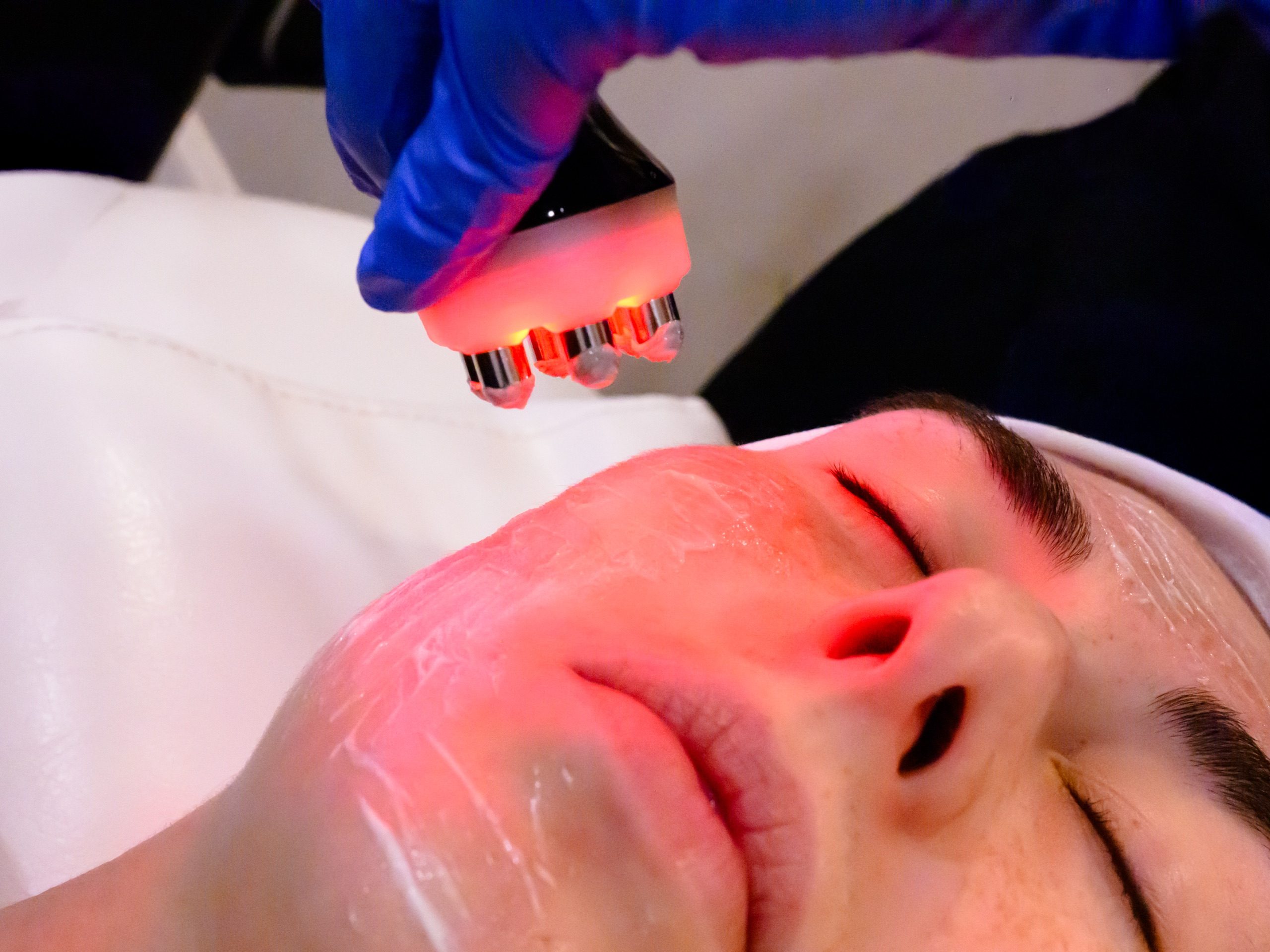 RF Face facial (6-Pole)- 5 - client