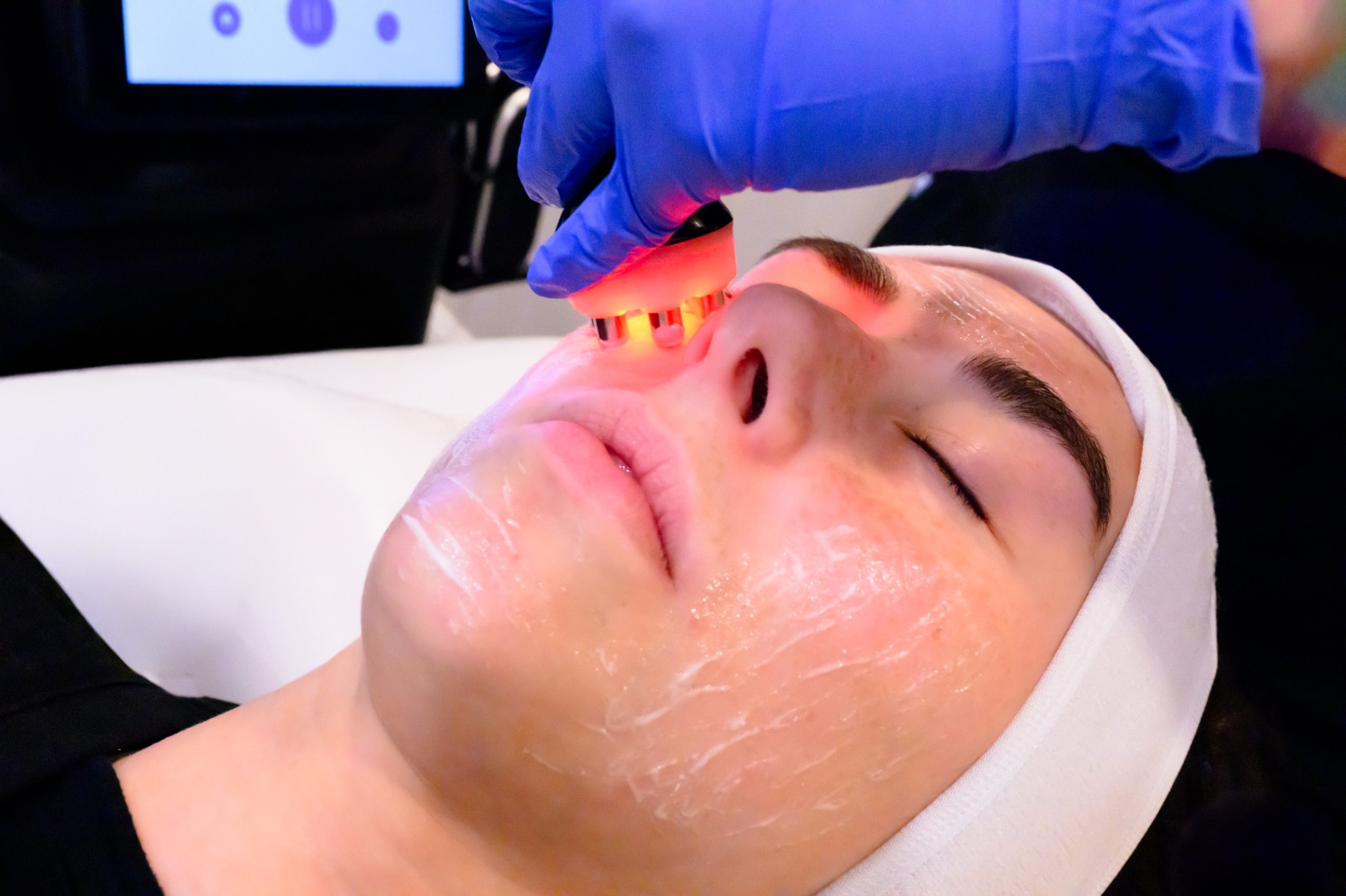 RF Face facial (6-Pole)- 6 - client