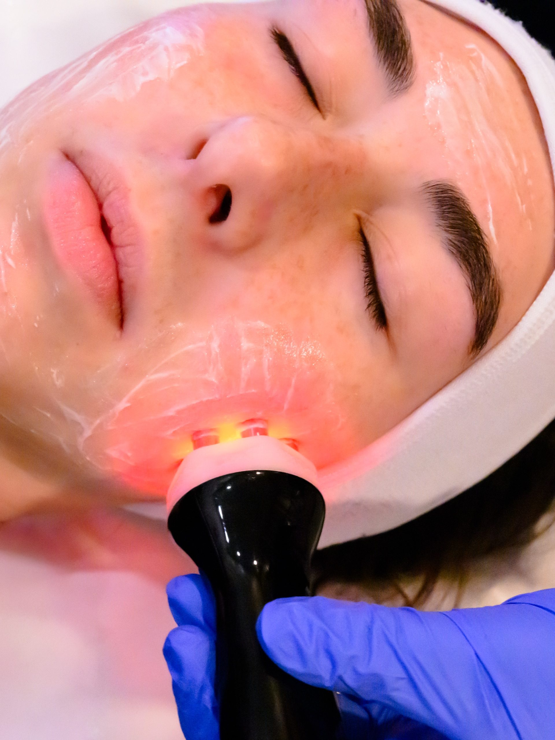 RF Face facial (6-Pole)- 7 - client