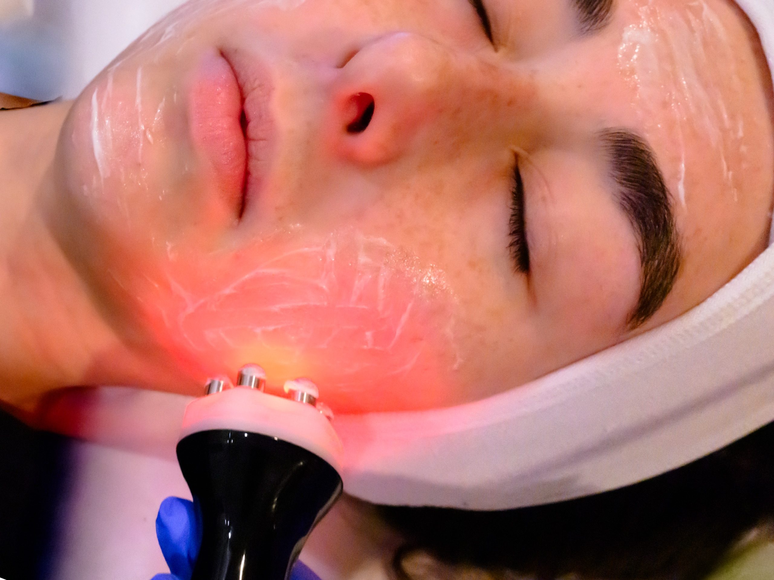 RF Face facial (6-Pole)- 8 - client