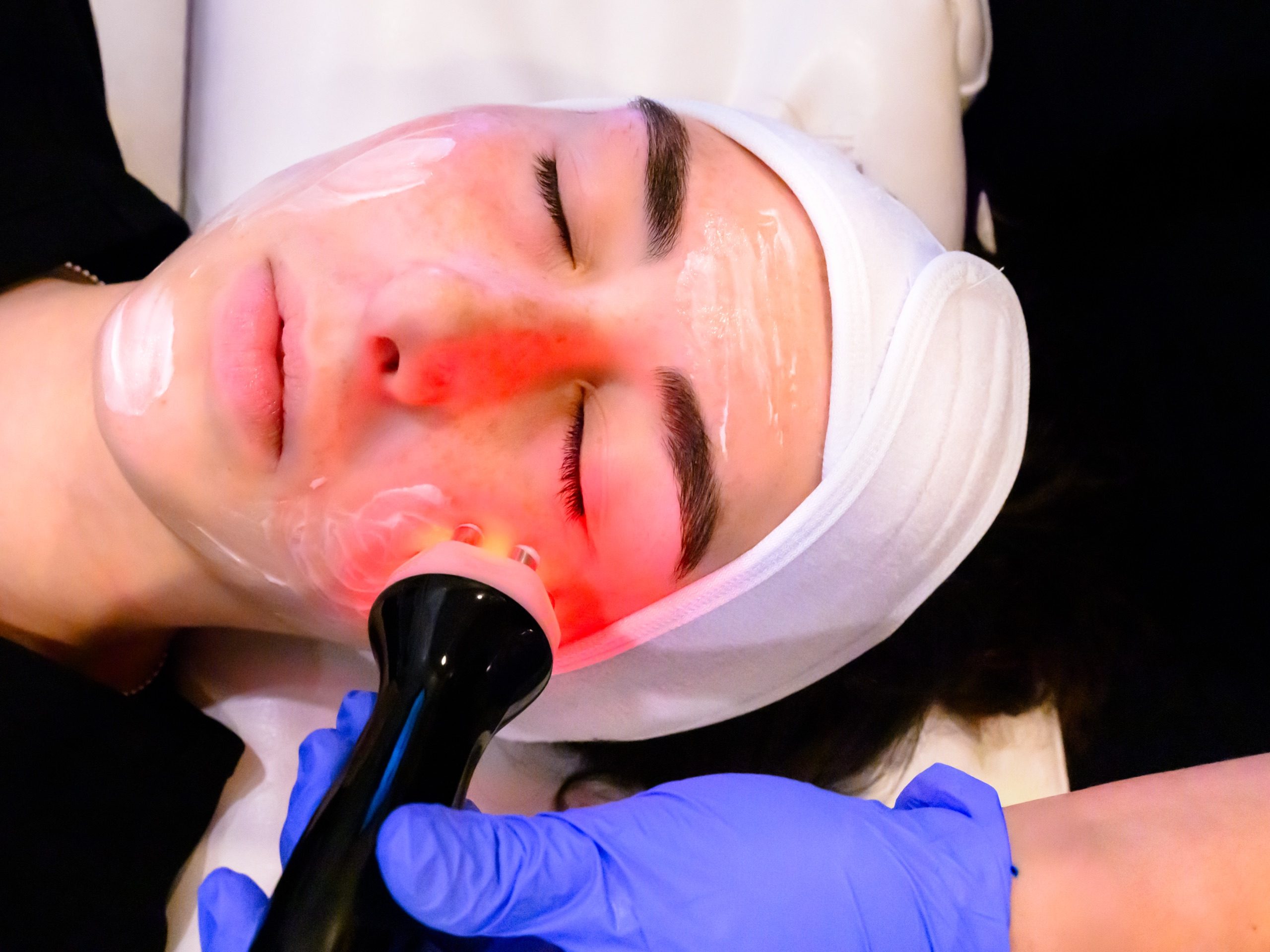 RF Face facial (6-Pole)- 9 - client